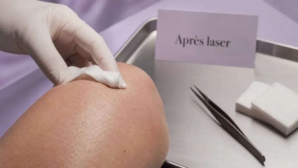 Après l’épilation laser, tirer sur les poils est le geste à éviter, pas le rasage