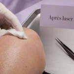 Tirer sur les poils après épilation laser : à éviter, compresse et peau traitée